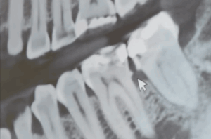 Periodontitis