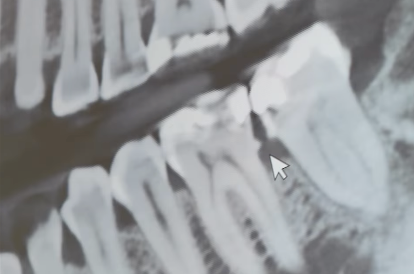 Periodontitis
