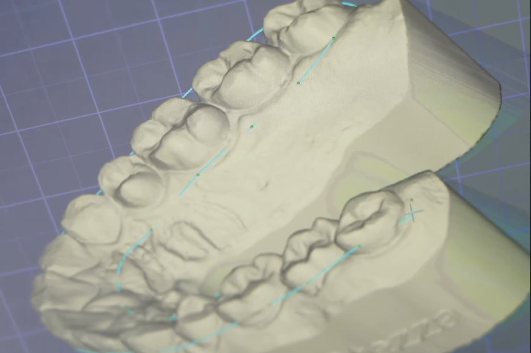 Exocad 3D