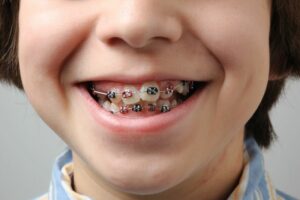 Tratamiento con brackets metálicos o cerámicos en Carrero & Tezza