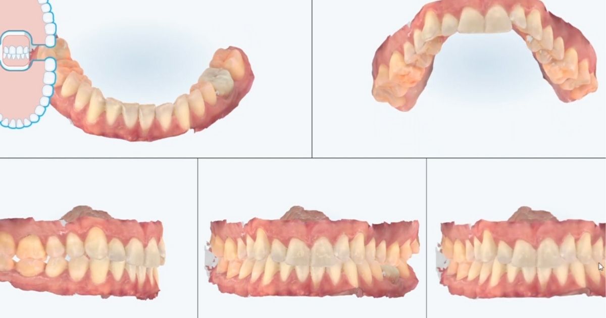 Simulación de nueva sonrisa con diseño digital en Carrero & Tezza