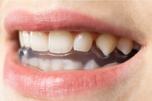 Férula de descarga colocada en los dientes para el tratamiento del bruxismo en Carrero & Tezza Clínica Dental.